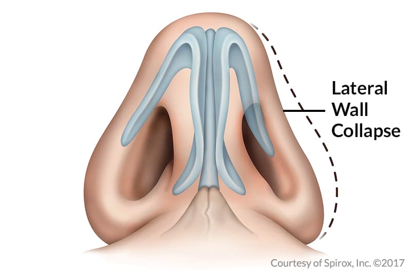 Diagram of nasal valve stenosis 4A7868BE-40FB-40D8-839C-C1BAD3EE2184