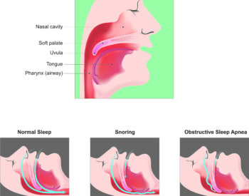 snoring and sleep diagram snoring and sleep diagram