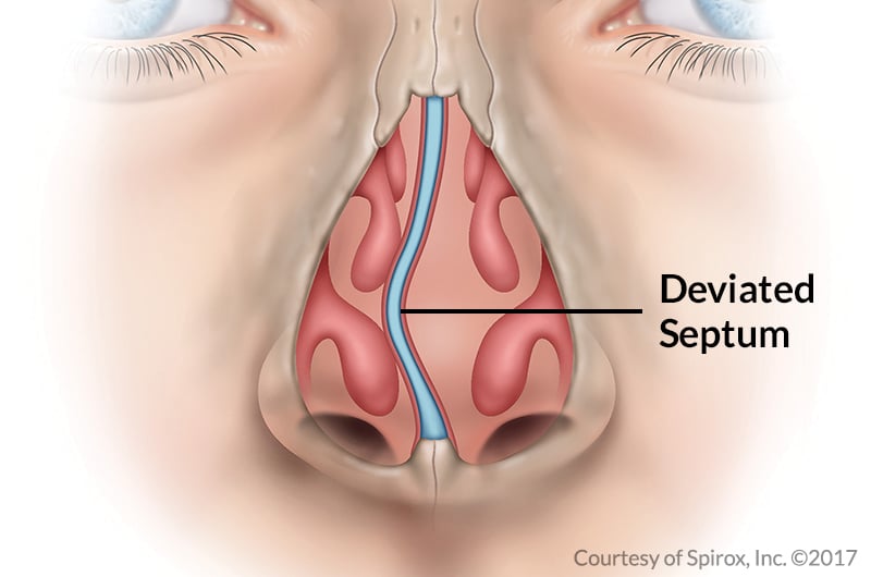 Nasal Septum Las Vegas NV
