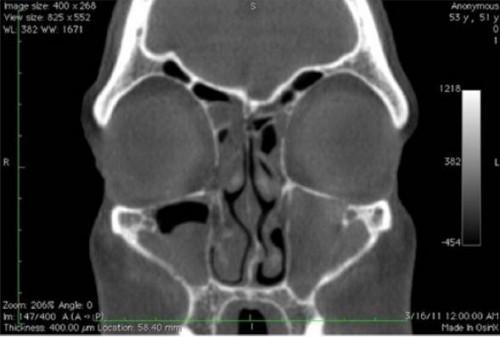 CT Sinus image coronal view