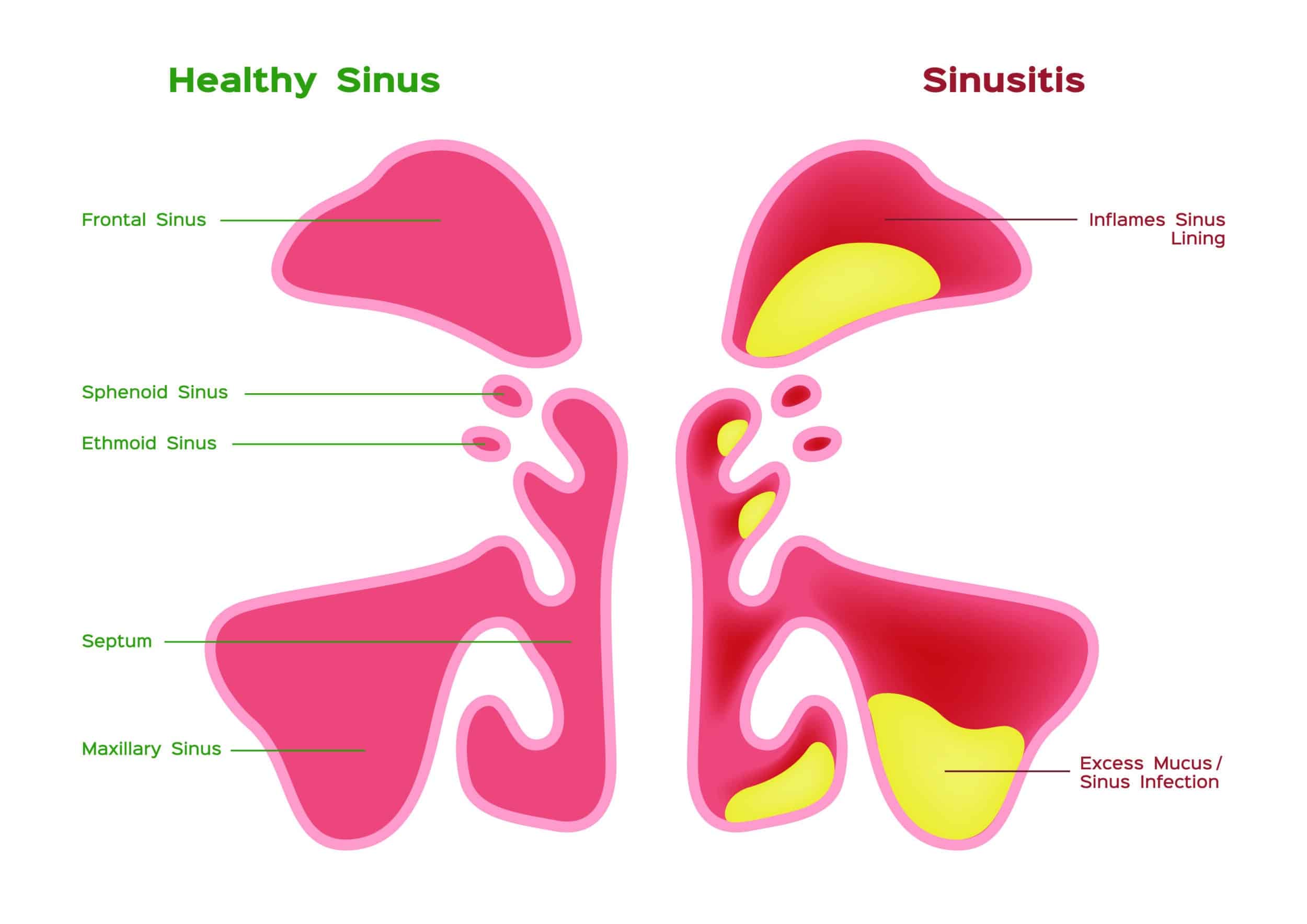 Healthy sinus versus sinus disease