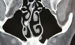 CAT scan image of a deviated nasal septum Deviated nasal septum