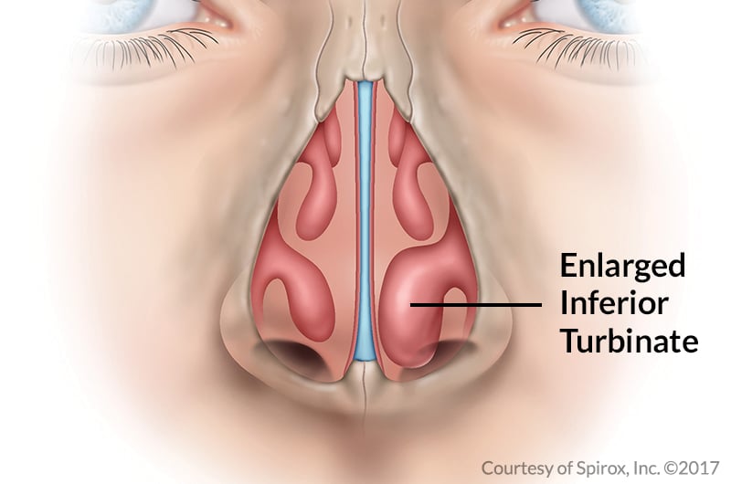Image of enlarged nasal turbinates