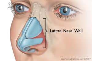 Facial diagram showing lateral nasal wall for nasal valve stenosis
