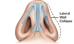 nasal valve collpase