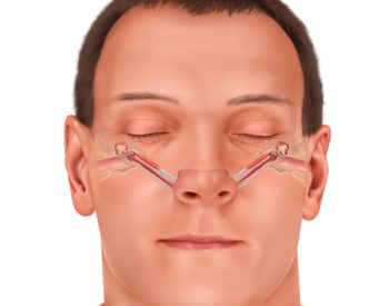 eustachian tube dilation eustachian tube dilation