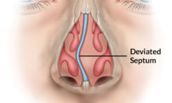 Image of a deviated nasal septum