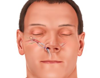 eustachian tube dilation