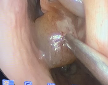 close up of nasal polyp being removed