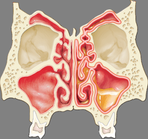 image healthy vs diseased sinus anatomy78