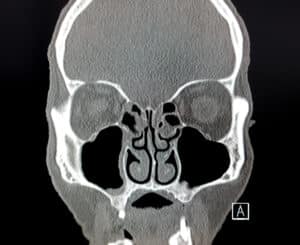 CT scan image of a man's sinus helps allow diagnosis for sinusitis